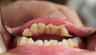 Dientes Negros: Discoloration, Tips